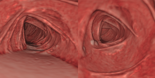 【11/17展示】仮想内視鏡や仮想的腸管洗浄、ポリープ検出の機能を備えた、下剤を使わないバーチャル内視鏡検査システム