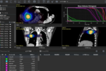高度ながん治療をアシストする放射線治療計画ソフトウェア 東北大学「アイラト株式会社」